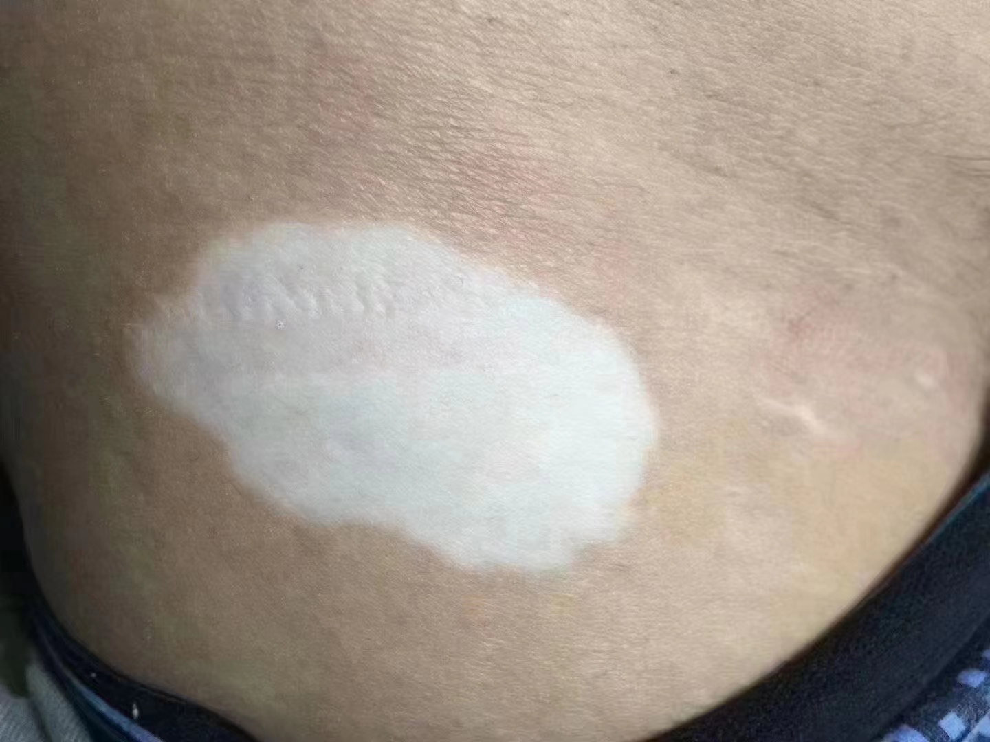 白癜风治疗几天的稍后对比，很多人都是白癜风是中西医治不好的病，其实是没找对医生，医易和皮肤专病专治，欢迎来电咨询132-2812-3168