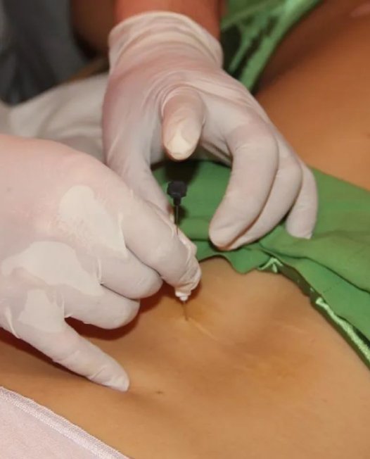 带你了解埋线治疗牛皮癣!(附图)