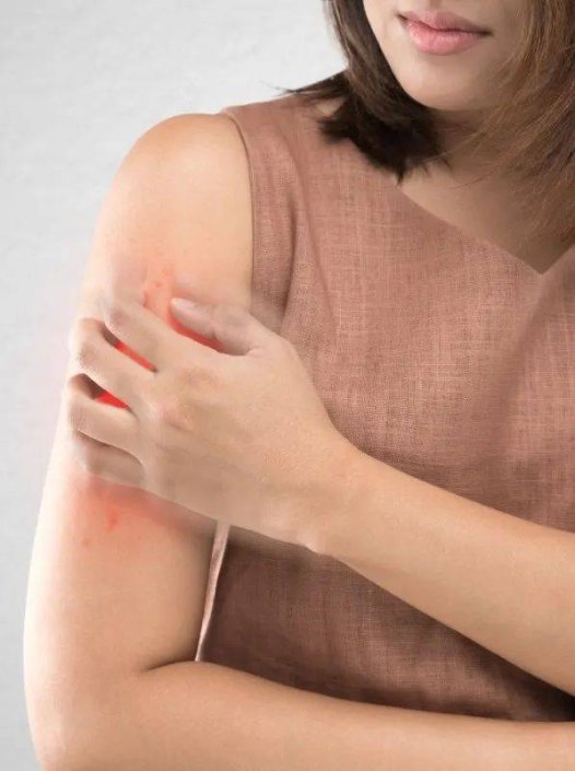 【穴位埋线疗法】——病根埋线疗法结合中药外治法治疗湿疹的分析讨论