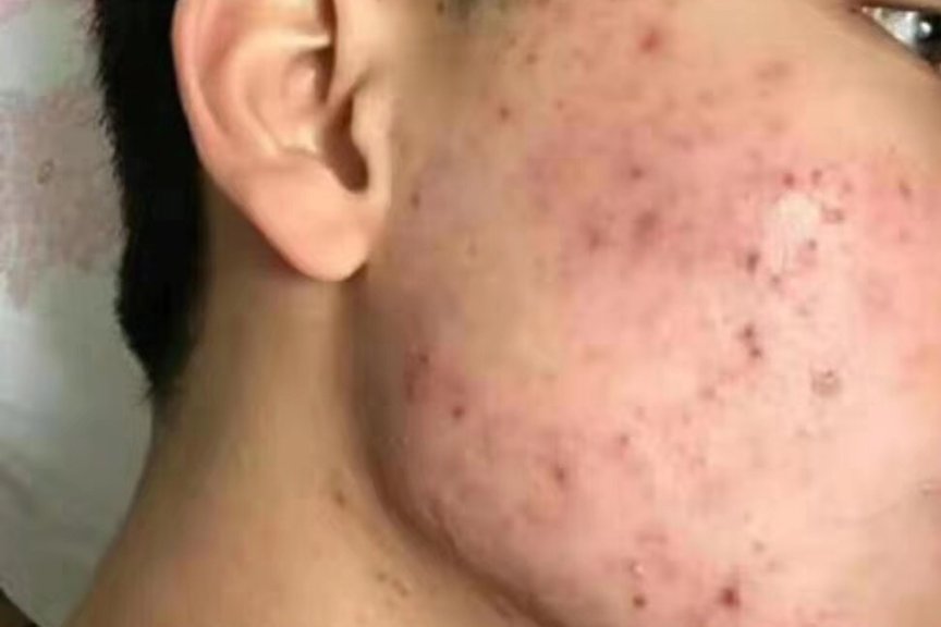 专业治疗痤疮-医易和专病专治