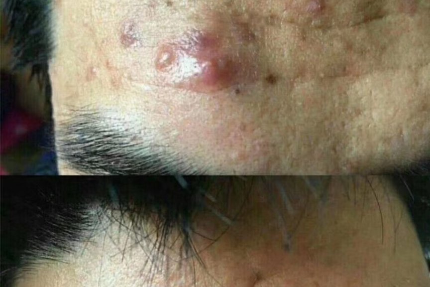 专业治疗毛囊炎-医易和国医堂专病专治