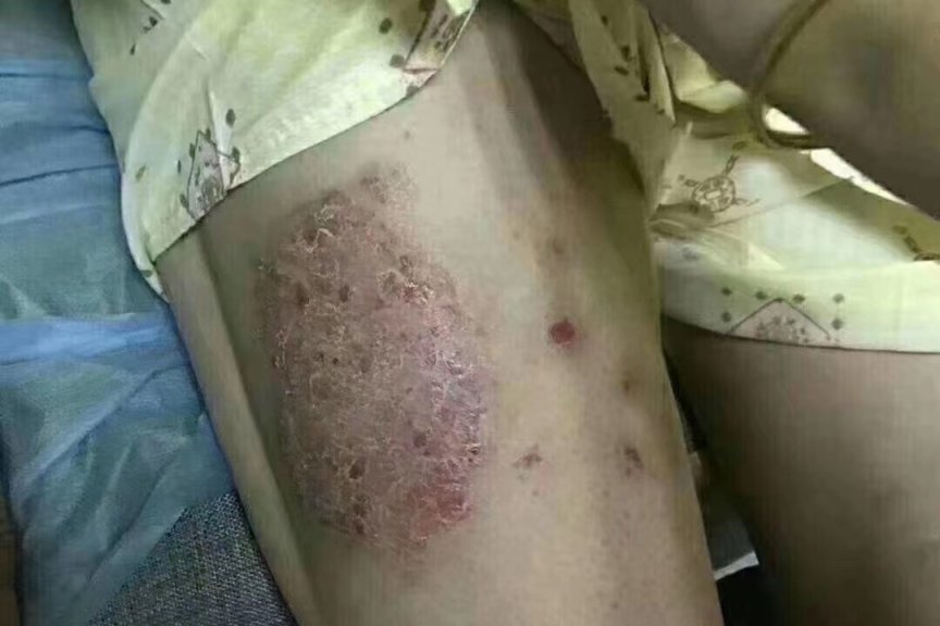 专业治疗癣-医易和专病专治