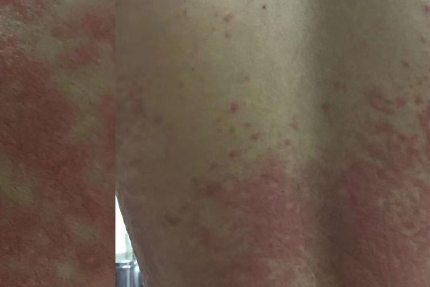 专业治疗丘疹性湿疹-医易和专病专治