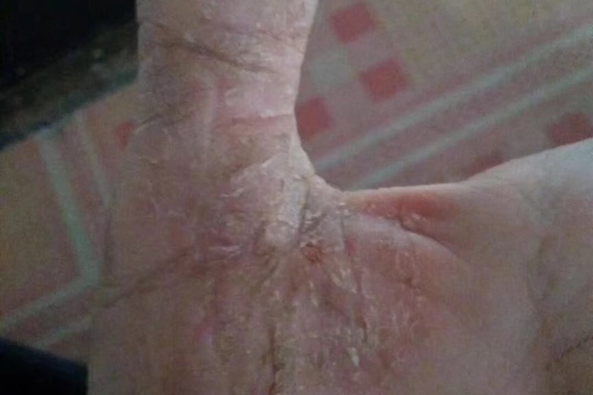 专业治疗角质松懈症-医易和专病专治