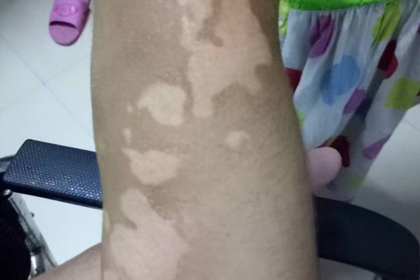 专业治疗白癜风-医易和专病专治