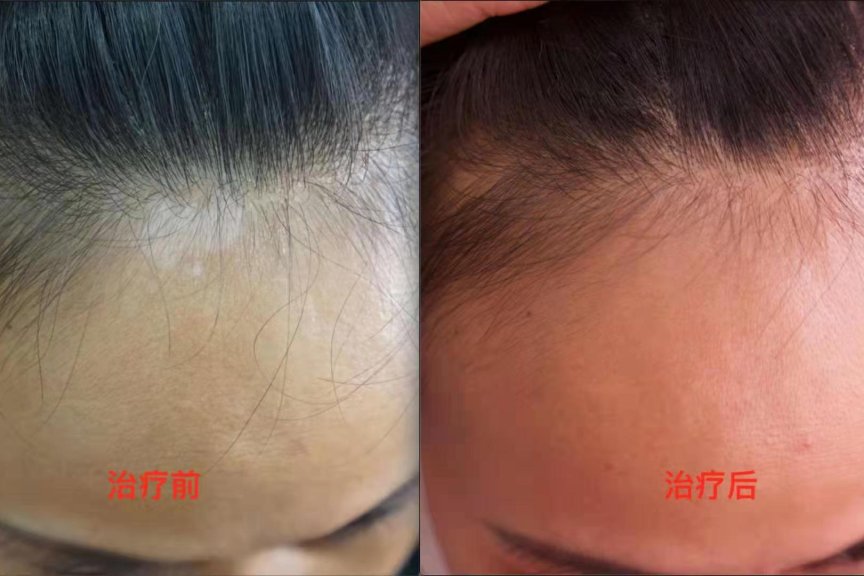 医易和纯中医专病专治皮肤头癣