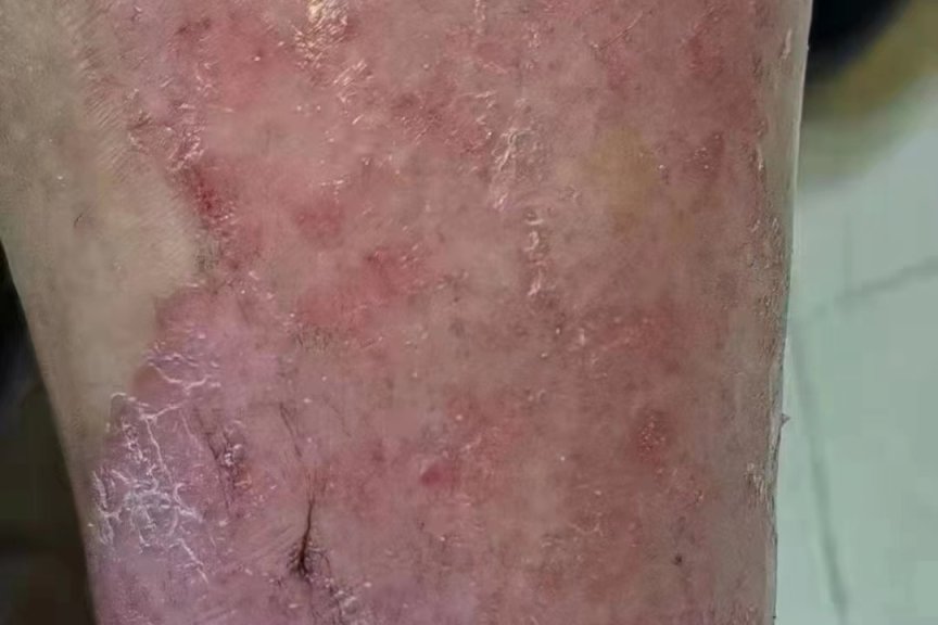 专业治疗牛皮癣-医易和专病专治