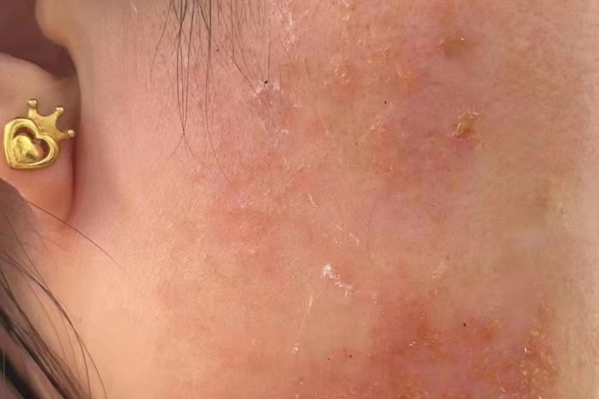 专业治疗皮炎-医易和专病专治