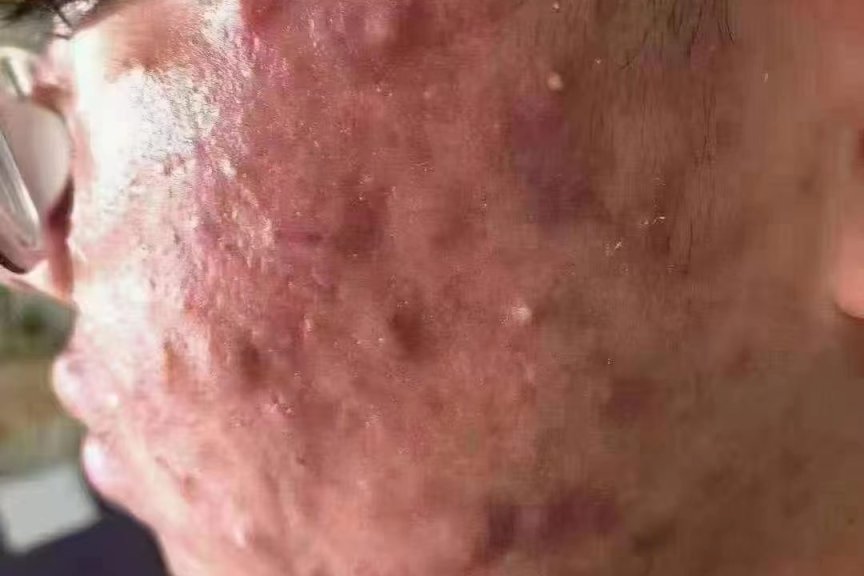 专业治疗脓包型痤疮-医易和专病专治