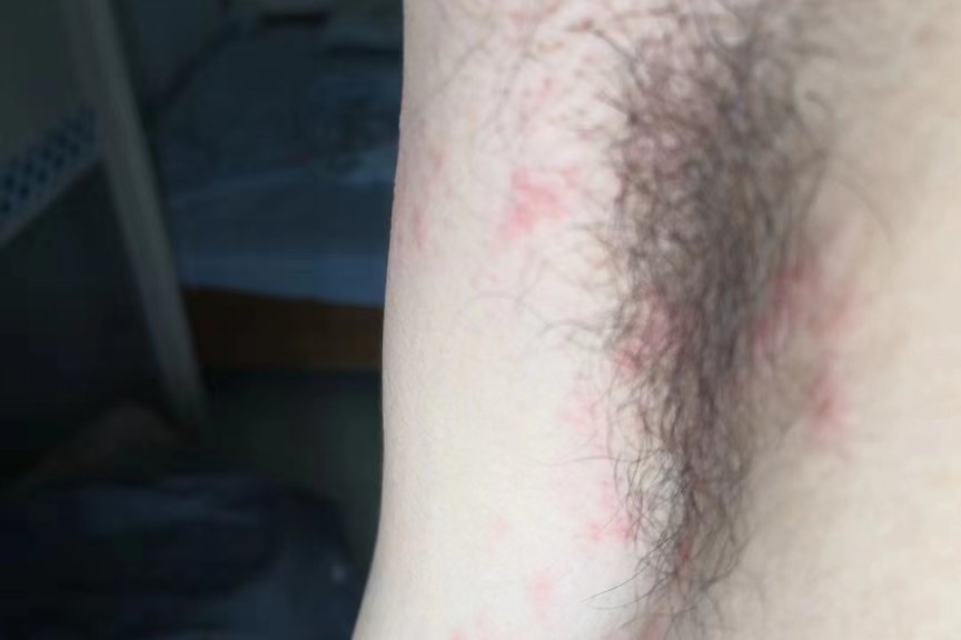 专业治疗带状疱疹-医易和专病专治