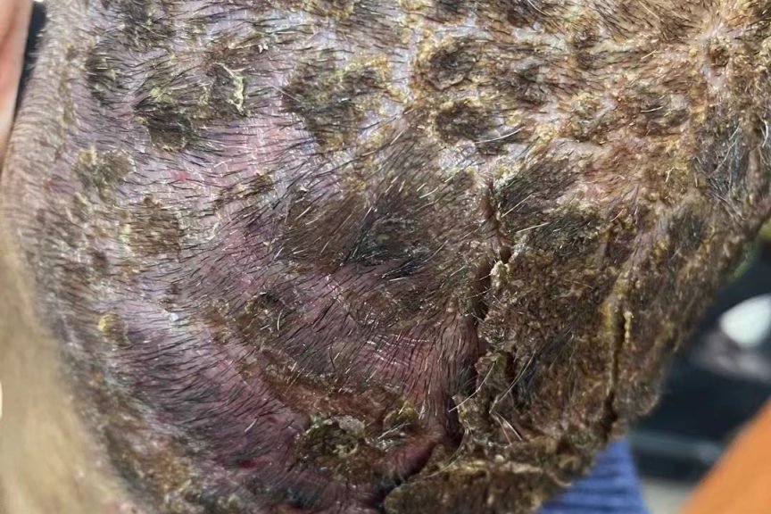 专业治疗脑癌毛囊炎-医易和专病专治