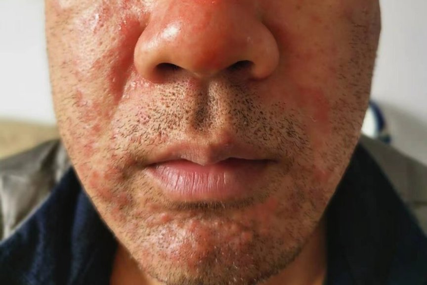 专业治疗湿疮-医易和专病专治