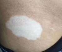 白癜风稍后几天效果明显