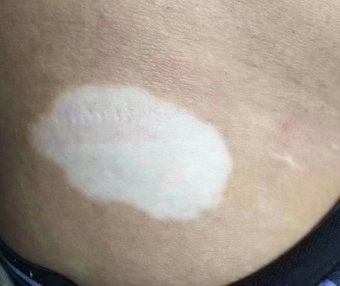 白癜风稍后几天效果明显