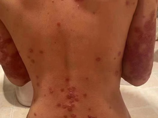 摆脱银屑病,纯中药为您保驾护航