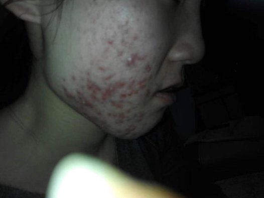 青春不灭,痘痕无痕——战胜青春痘的秘诀!