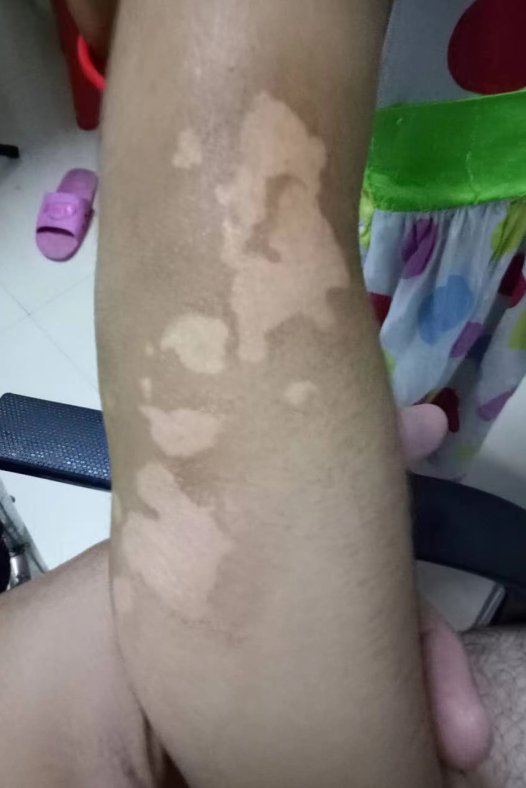 白癜风患者的福音,真实案例分享,重拾美丽自信!