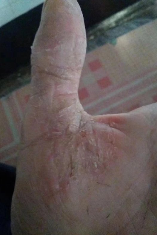 角质松懈症治愈:真实案例重塑信心