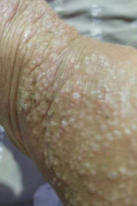 纯中药治疗慢性湿疹